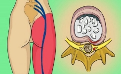 Une crise du nerf sciatique? Ce simple exercice vous débarrasse de la douleur de la sciatique !